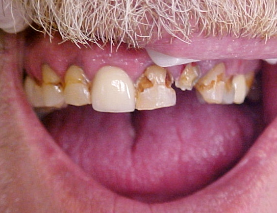decayed tooth before