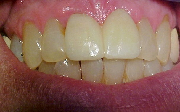 straight and white teeth after
