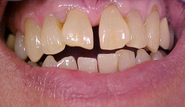 gapped teeth before