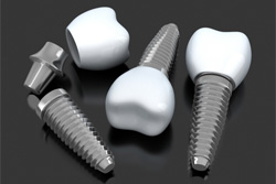 Closeup of dental implants in Plano on dark background