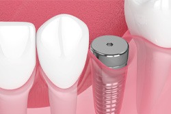 Digital illustration of dental implant  