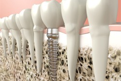 Digital illustration of dental implant in jawbone  