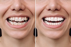 A before and after of cosmetic dental treatment