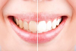 before and after teeth whitening