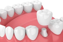 dental crown illustration