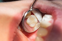  Dentist in Plano placing a tooth-colored filling
