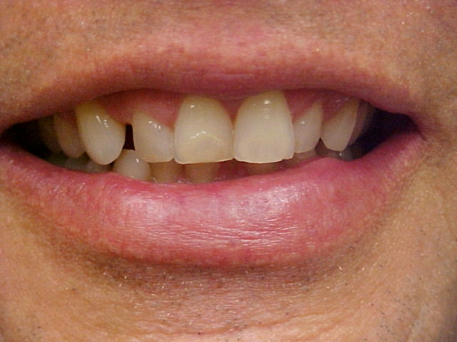 missing teeth before