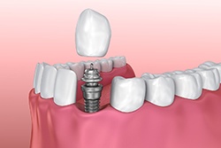 Image of each dental implant component. 