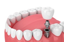 Digital illustration of a single tooth dental implant in Plano 