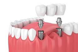 Digital illustration of implant bridge replacing multiple missing teeth in Plano 