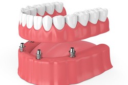 Digital illustration of an implant denture in Plano 