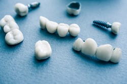 different types of dental implants in Plano on blue background  