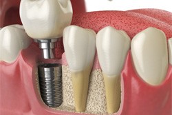 Digital illustration of dental implants in Plano 