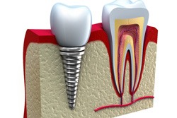 Digital illustration od a single tooth dental implant in Plano  