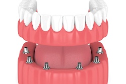 implant-retained denture