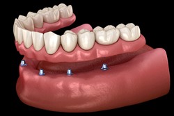 implant-supported denture