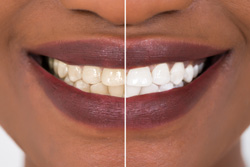 a before-and-after photo showing teeth whitening results