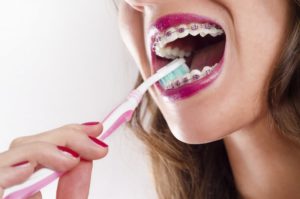 A person with braces brushing their teeth.