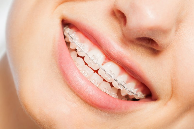 Closeup of patient smiling with clear braces